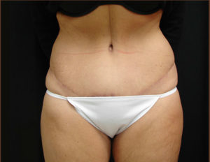 4 Questions to Ask Before Tummy Tuck Surgery - Basu Aesthetics