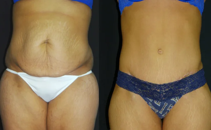 Tummy-Tuck-Liposuction-Before-And-After-Virginia-Beach-Plastic-Surgery-001-Cover