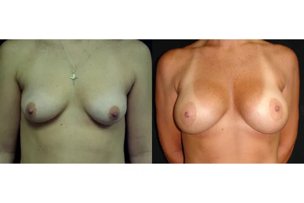 breast-augmentation-and lift-before-and-after-virginia-beach-plastic-surgeon-VA-106-MJD