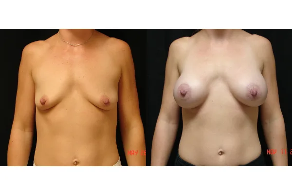 breast-augmentation-before-and-after-virginia-beach-plastic-surgeon-VA-102-MJD
