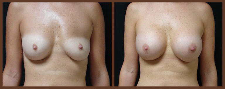breast-revision-before-and-after-1-virginia-beach-plastic-surgeon-VA-0050-JSA