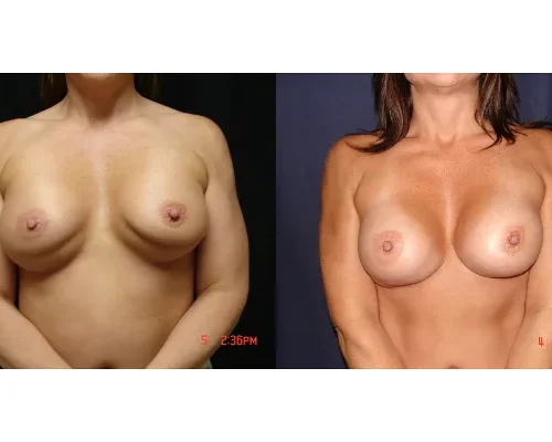breast-augmentation-revision-before-and-after-virginia-beach-plastic-surgeon-VA-101-JSJ