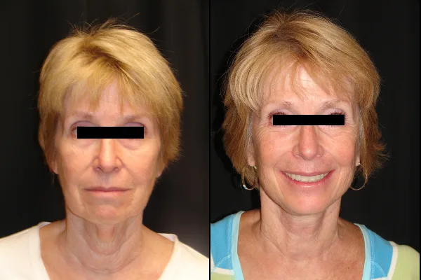 facelift-before-and-after-virginia-beach-plastic-surgeon-VA-102-denk