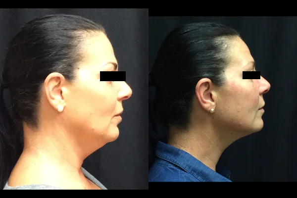 injection-before-and-after-virginia-beach-plastic-surgeon-VA-103-JSA