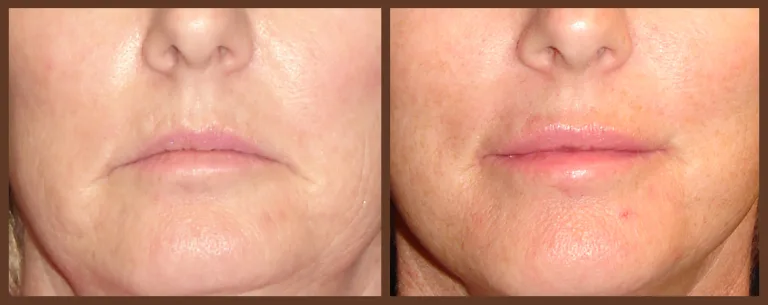 lip-before-and-after-1-virginia-beach-plastic-surgeon-VA-0160-denk