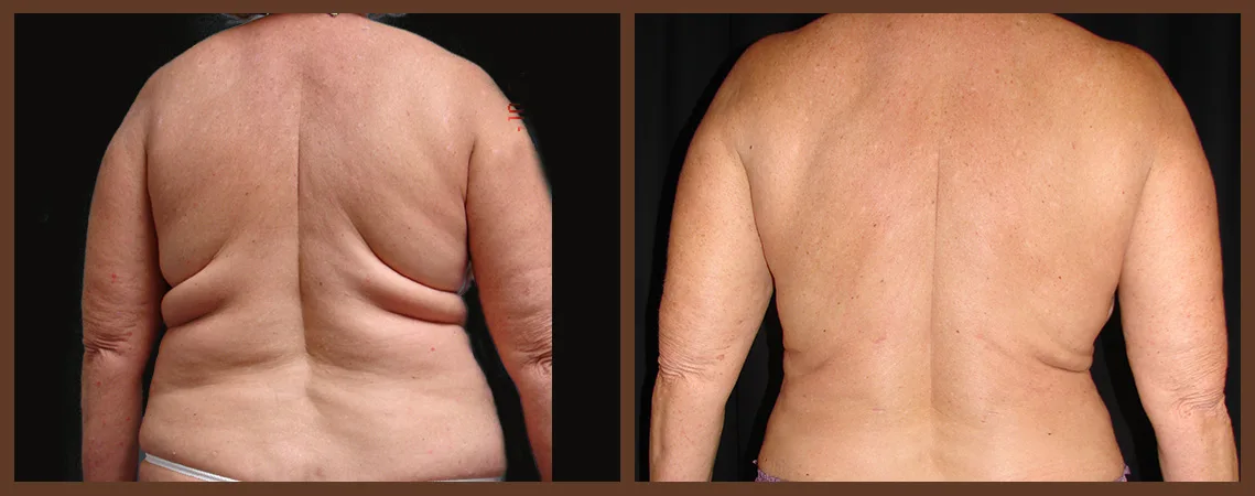 Liposuction of Flanks Before and After 3804