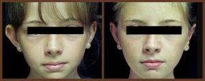 otoplasty-before-and-after-1-virginia-beach-plastic-surgeon-VA-0125-denk