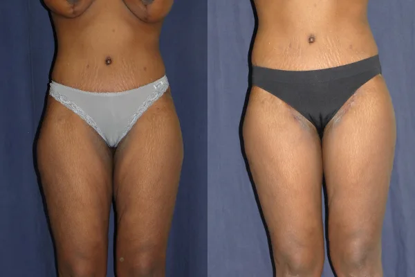 thighlift-before-and-after-1-virginia-beach-plastic-surgeon-VA-Denk